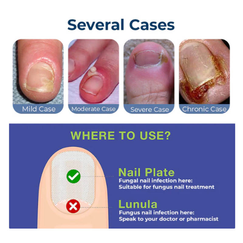 ToenailPlus Anti-Nail Groove Relief Oil Soft Nail Bright Nail Repair Ingrown Nail Thickening Nail Groove Care OilNail Groove Care OilBrand: ToenailPlus
Brand Type: OEM
Whether to import: No
Efficacy: Other
Specifications: Sample
Color classification: 10ml (for export sales only, domestic sales prohibited, purchase equals default disclaimer)
Main downstream platforms: AliExpress, Independent Station, Others
Whether cross-border export exclusive supplier: Yes
Special Purpose Cosmetics: No
Category: Body Care Set
Product name: Anti-Autoimmune Thyroid Relief OilNail Groove Care OilML Clinic  for Wellness